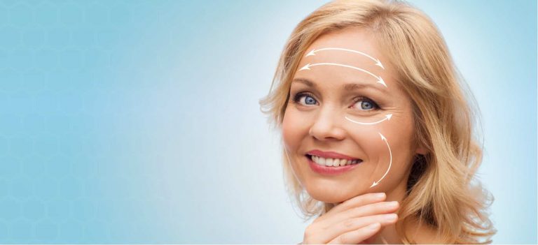 a woman smiling with white lines on her face indicating the process of a facelift