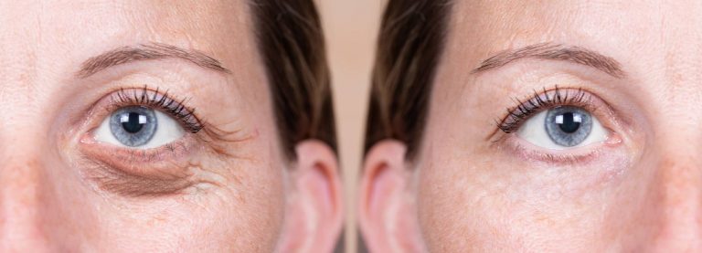 A woman before and after eyelid surgery