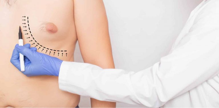 A surgeon marking body for pseudogynecomastia.